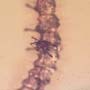Rare Beetle Larva With Mite On Top, Cool Bubble On Its Mouth And Two Mites In Dominican Amber